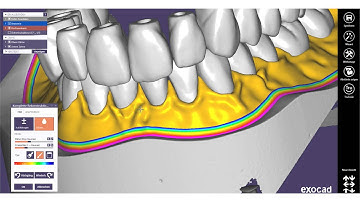 EXOCAD TUTORIAL 2016 - FREE  - Gingiva Modellation by Michael Anger