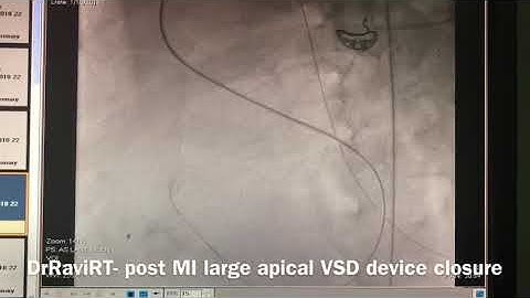 DrRaviRT- Large Post Myocardial Infarction Apical VSD transcatheter device closure