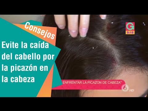 Vídeo: Picazón En El Cuero Cabelludo Con Pérdida De Cabello: ¿están Los Dos Conectados?