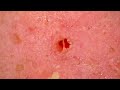 0301 keratin plug removal nose