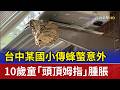 台中某國小傳蜂螫意外 10歲童「頭頂姆指」腫脹