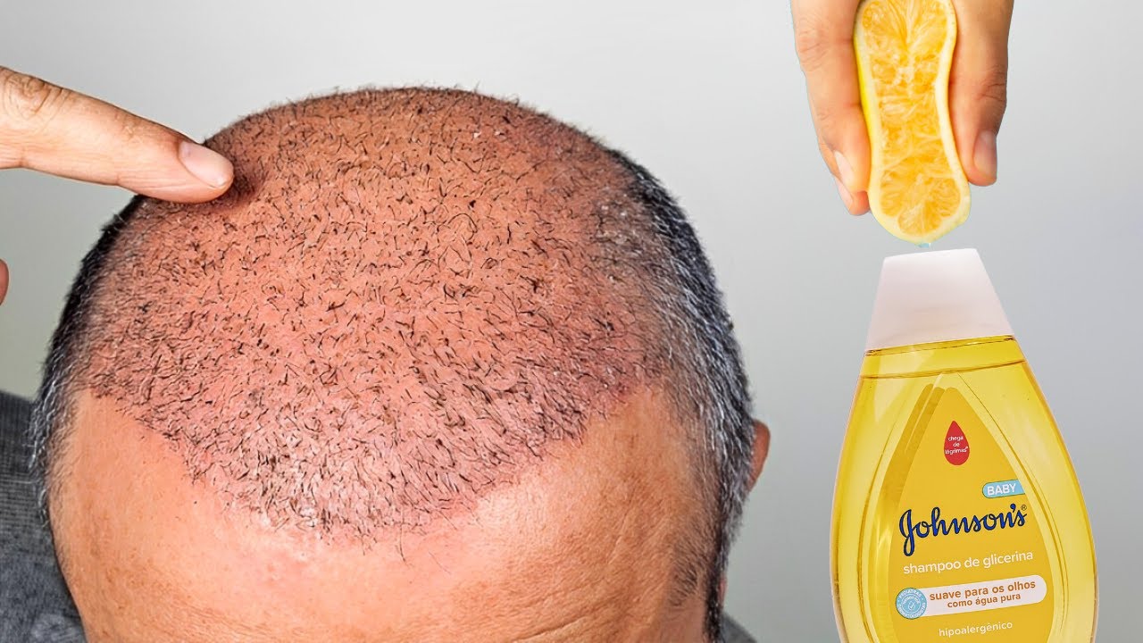 Adicione isso ao shampoo 🌱 O cabelo cresce loucamente e a calvície vai embora