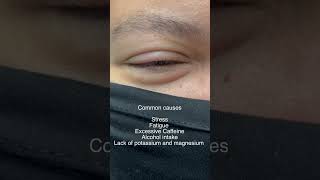 Myokemia or Eyelid Twitch