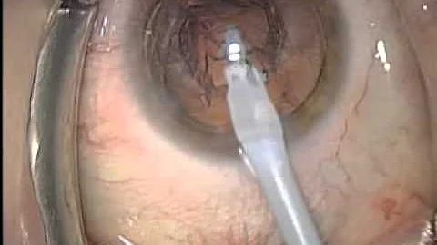 Cataract Surgery by Dr. Todd Fladen of The Fladen ...
