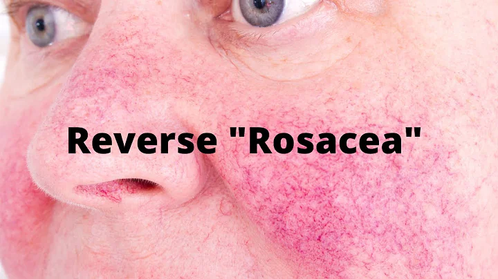 Reverse The Redness "Rosacea" With The Keto Diet