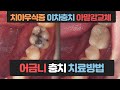 증상 별 어금니 충치 치료 방법은 어떻게 다를까? (치아우식증, 이차충치, 아말감 교체) 磨牙（大牙）治疗方法