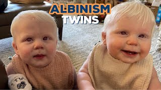 'My twin daughters were born with albinism - people gawk at them in the street'  | LOVE THIS! by SWNS 152 views 2 days ago 1 minute, 3 seconds