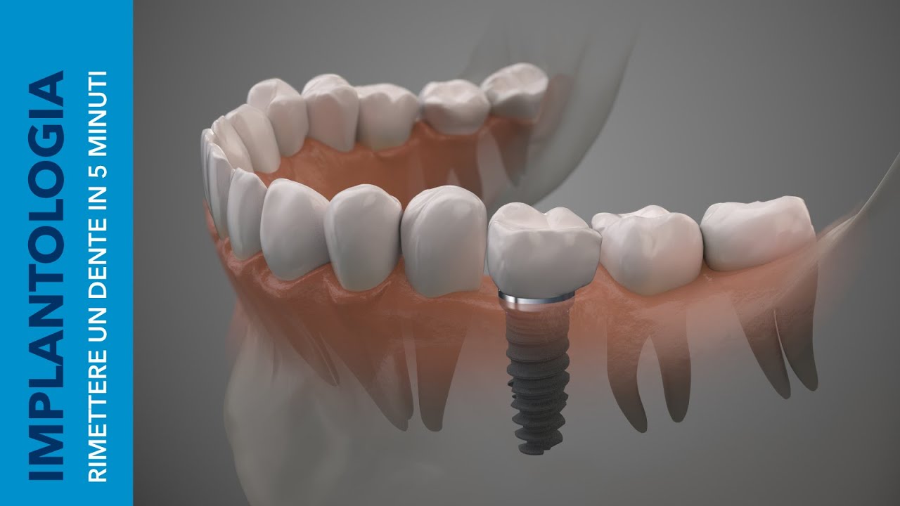 IMPIANTO SINGOLO Come rimettere un Dente in circa 5 Minuti? YouTube IMPIANTO SINGOLO Come rimettere un Dente in circa 5 Minuti? YouTube