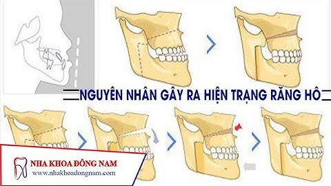 Nguyên Nhân Gây Ra Hiện Trạng Răng Hô | NHA KHOA ĐÔNG NAM®