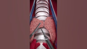 Thyroidectomy procedure  (3D Animation) #music #doctor #heartbit #remix #science #nurse #pregnant