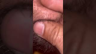 Root Removal#RootOut#HairFix#SkinAsmr#DeepPull#CleanClip#MacroView#HairOut#sounds #tissuwax