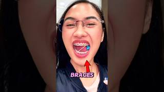 Never chew gum if you’ve got braces on!