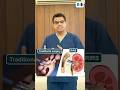 RIRS vs Traditional Surgery 😲 Kaunsa Hai Best Choice?
