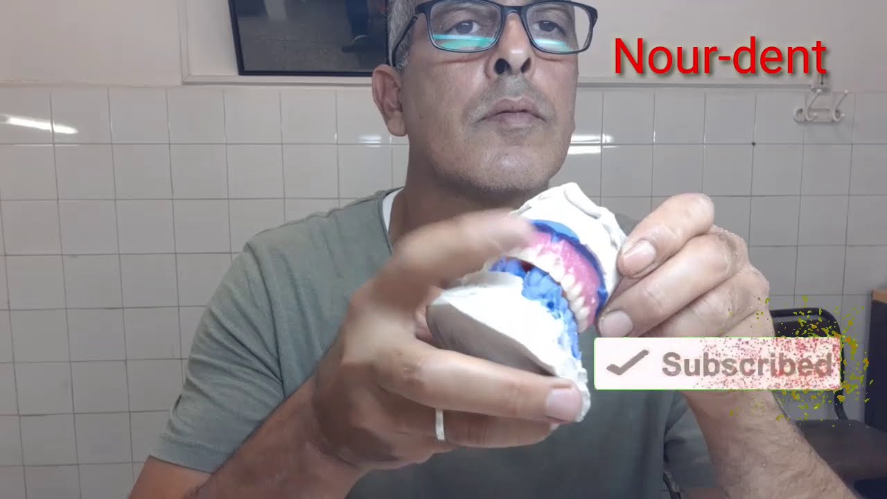 Montage du total du haut. et finition de la cire. #dentaire #Appareil@NoureddineVlogsBr