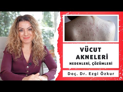 Vücut Akneleri; Neden Olur? Nasıl Geçer?