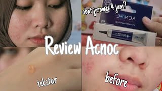 Review Obat Jerawat Acnoc- Beneran Bisa Hilang Dalam 4 Jam? Review Acnoc Acneser Spot Gel