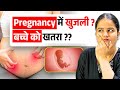 Pregnancy में खुजली: Ignore न करें ये Signs! Itching in Pregnancy- Causes,Warning Signs &amp; Treatment 
