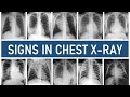Signs in Chest X-ray