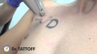 HoustonTattoo Removal - Chest Tattoo Removed at Dr TATTOFF Laser Tattoo Removal Clinic in Houston TX