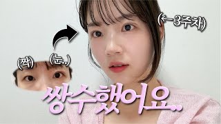 쌍수 후 3주 간 붓기 변화 | 짝눈의 쌍커풀 수술 후기 👀 (쌍수하고 세상에서 운동 제일 많이 하는 사람.. 쌍수하고 씻기, 추천템까지!)