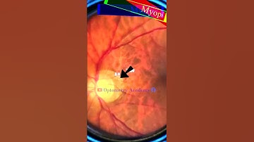 Myopic Crescent | Fundus Photography | Myopic Fundus | Short Video 227  #viral #optometryacademy