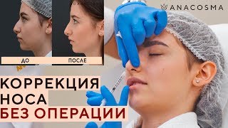 Как убрать ГОРБИНКУ НА НОСУ👃 Безоперационная ринопластика филлером