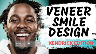 Digital Smile Design | How To Design Porcelain Veneers Digitally