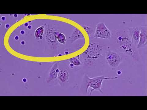 Video: Interleukiini-15 Syövän Immunoterapiassa: IL-15-reseptorikompleksi Vs. Liukoinen IL-15 Syöpäsoluilla Toimitetussa Hiiren Leukemiamallissa