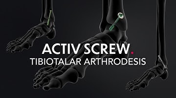 Activ Screw - Tibiotalar Arthrodesis