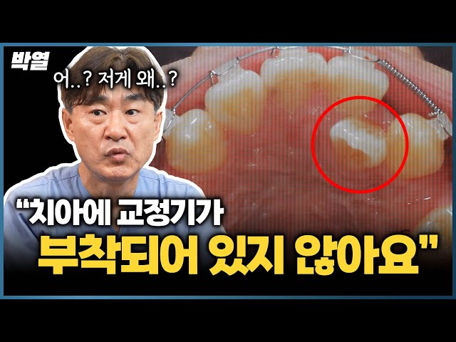 안쪽에 깊게 박힌 덧니! 어떻게 교정하는지 궁금하신가요? #치아교정 #덧니교정