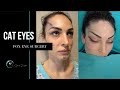 Cat eye or fox eye surgery  by op dr yucel sarialtin