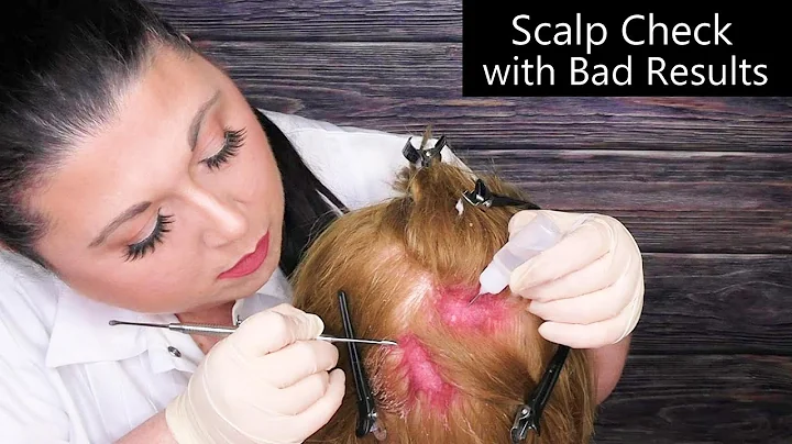 ASMR Scalp Check with Bad Results (Scalp Treatment, Whispering, Scalp Massage) Medical Roleplay