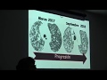 Fibrosis Pulmonar Idiopática/Dra. Mayra Mejia