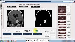 Brain tumor detection and classification | MATLAB Final Year Project