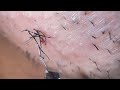 Plucking facial hair & ingrown hair 952 頬髭抜き(埋没毛あり)