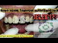 Siapa Bilang Menambal Gigi di Puskesmas Dengan BPJS Kesehatan Hasilnya Jelek