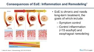 The Latest on New Options for Eosinophilic Esophagitis: Considering Targeted Biologic Therapy