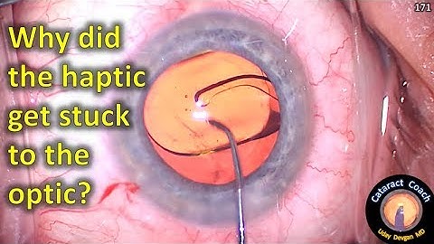 when the haptic gets stuck to the IOL optic during cataract surgery