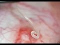 There's a worm in my eye! Loa Loa worm removed from eye in Austin, TX.  Shannon Wong, MD. 3-10-2016