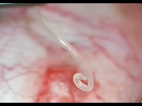 ვიდეო: Eyeworm ინფექცია ძაღლებში