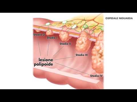 Video: Rimozione Di Un Polipo Nello Stomaco: Tipi Di Operazioni, Conseguenze, Dieta