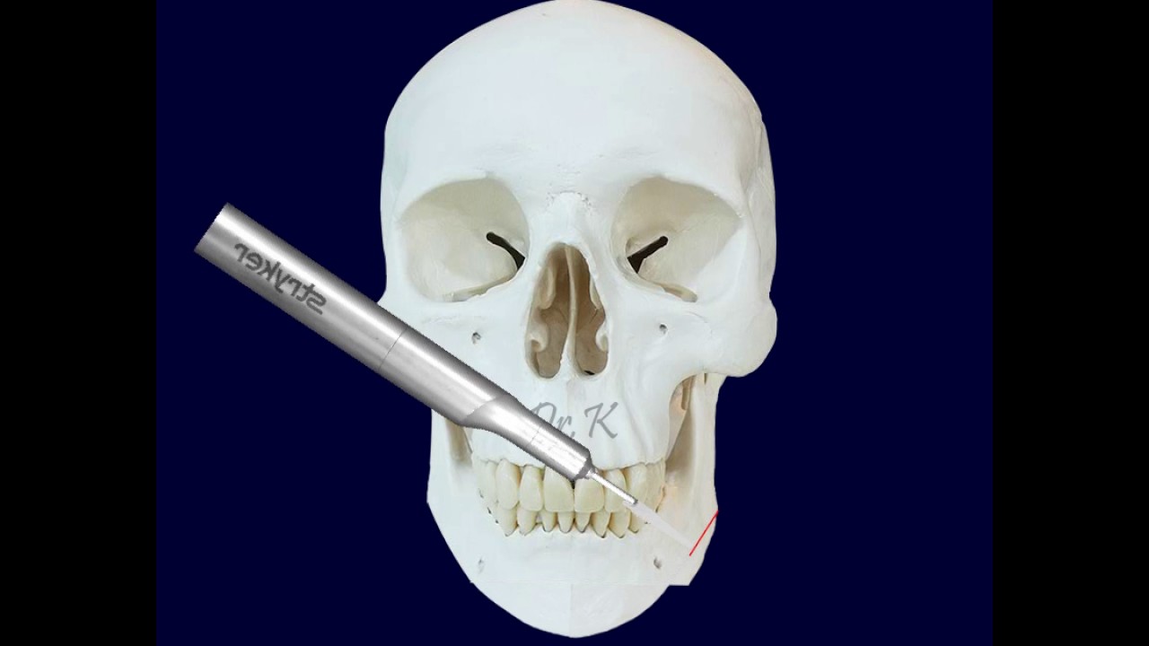 facial contouring surgery / 안면윤곽 동영상
