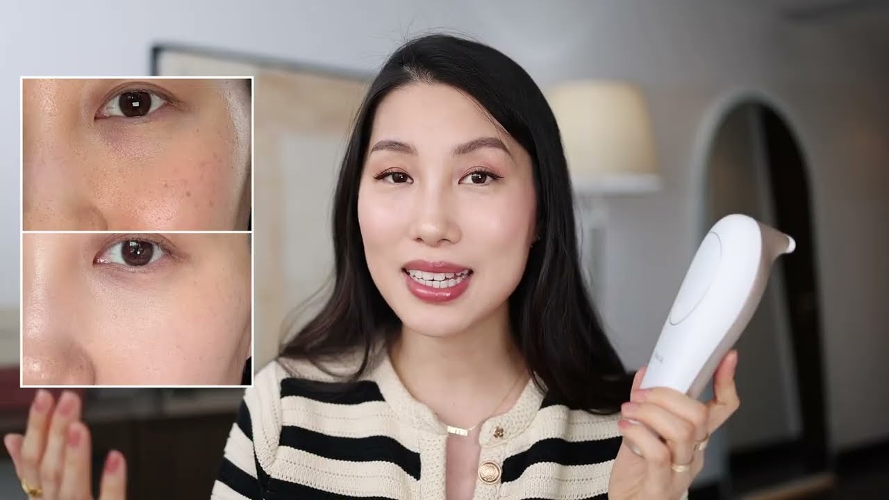 I Tried MimiSilk Iris 1450nm Laser Device | At-Home Laser for Wrinkles Fine Lines & Texture