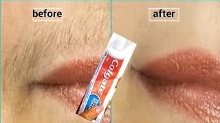 remove unwanted facial hair parmanetly 3 days result 2