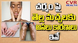 How to Cure Vitiligo | Causes of Vitiligo | White Patches | Dermatologist Dr.Kavitha Raj | Cvr