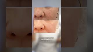 До конца ноября в моей клинике для новых пациентов: фототерапия всего от 6300 рублей! #акне #уход