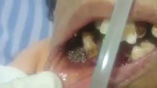 Dentist Opens Patient's Mouth, Finds ACTUAL Maggots In Teeth