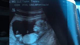Iman Shumpert And Teyana Taylor Share Pregnancy Ultrasound With The World