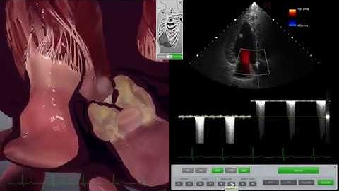 HeartWorks Aortic Stenosis with Doppler