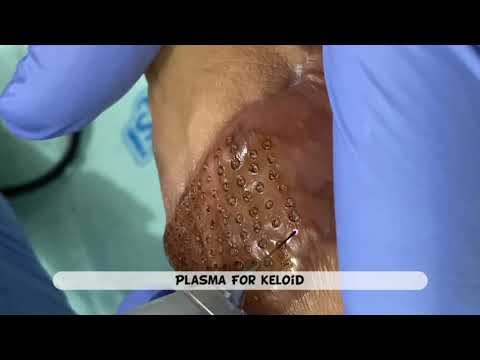 Videó: Az 5a-oleandrin Hatása A Keloid Fibroblast Aktivitásra